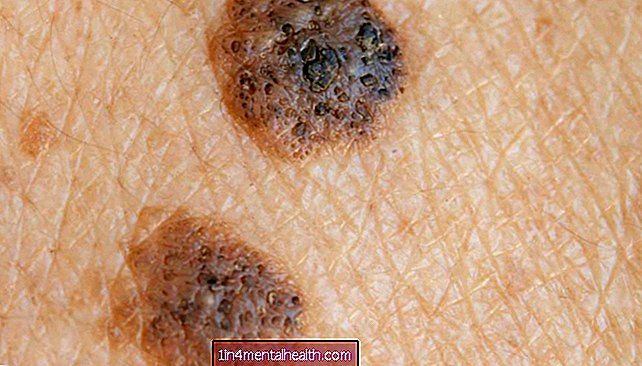 Je to seboroická keratóza nebo rakovina kůže?