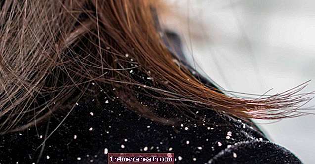 Czy istnieje związek między łupieżem a wypadaniem włosów? - dermatologia