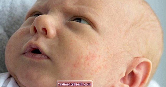 Är detta utslag baby akne eller eksem? - dermatologi