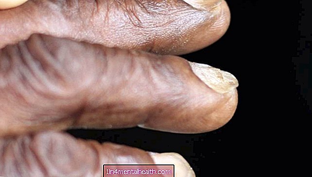 Koilonychia: Защо ноктите ми са с форма на лъжица?