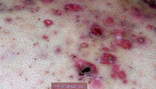 結節性痒疹：定義と治療の選択肢