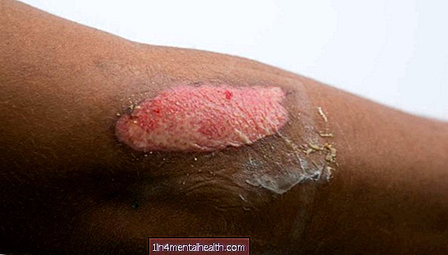 dermatologie - Brûlure au deuxième degré: tout ce que vous devez savoir