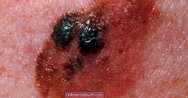 Trinn 4 melanom: Hva du trenger å vite - dermatologi