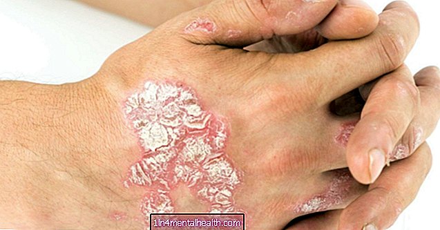 Quais são os sintomas da psoríase em placas? - dermatology