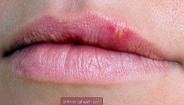 Какво може да причини подутина на устната? - дерматология
