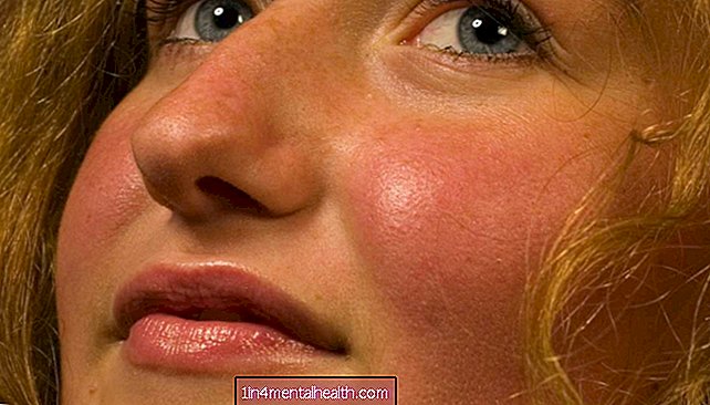 Mis võib põhjustada naha punetust?