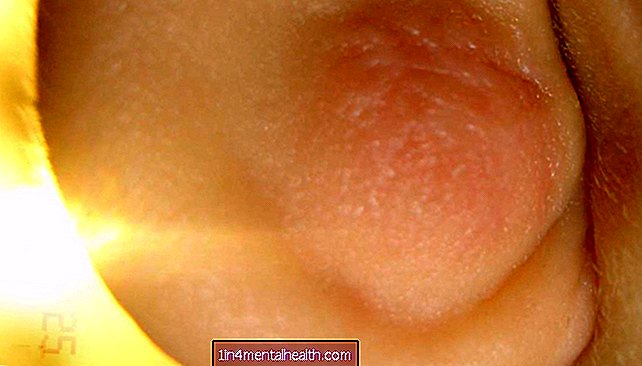 O que causa um cisto no lóbulo da orelha? - dermatology