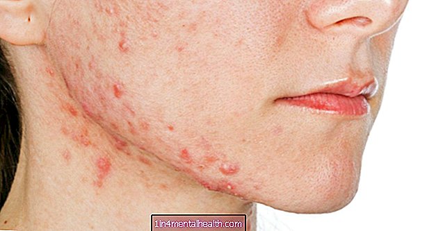 O que causa acne no maxilar? - dermatology