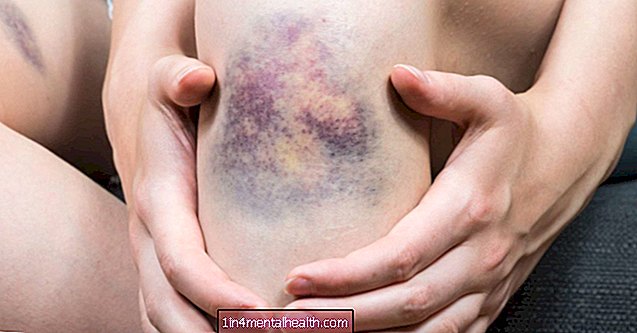 Hva forårsaker blødning i huden? - dermatologi