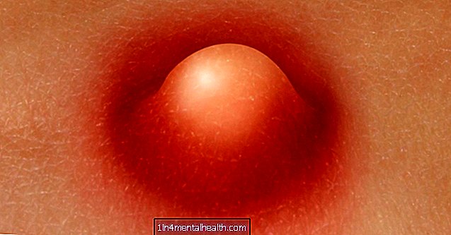 O que causa furúnculos na parte interna da coxa?