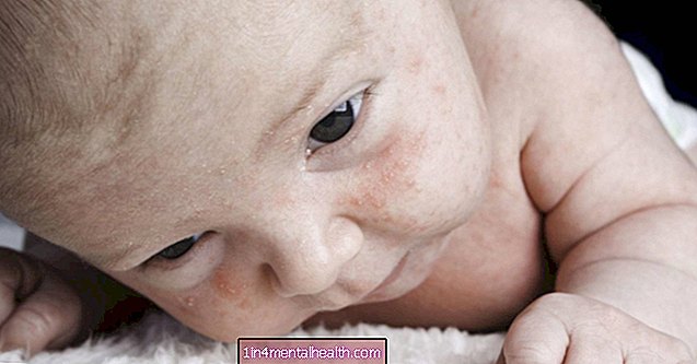 Was verursacht trockene Haut im Gesicht eines Babys?