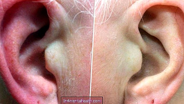 Mis põhjustab kuumaid ja punaseid kõrvu? - dermatoloogia