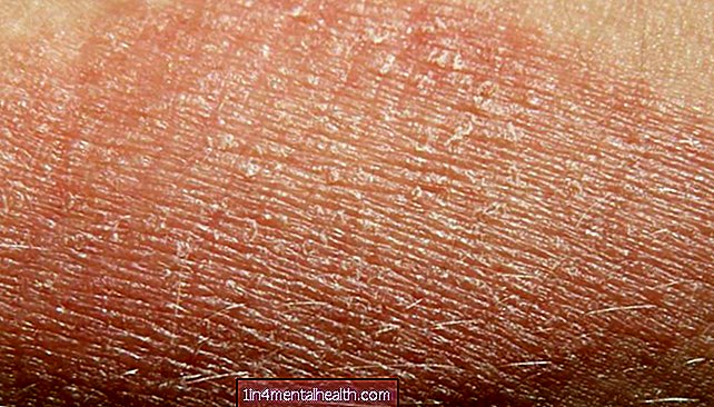Kas izraisa sausas ādas plankumus? - dermatoloģija