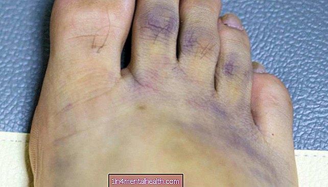 Qu'est-ce qui cause les pieds violets?