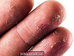Nguyên nhân nào khiến da đầu ngón tay bị bong tróc?