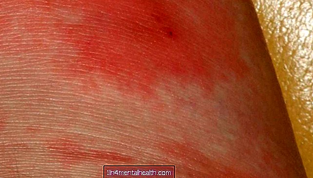 Kako izgledaju infekcije kože?
