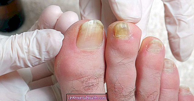 Що означають жовті нігті на ногах?