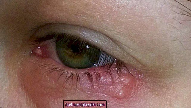 ¿Cómo se ve el herpes ocular?