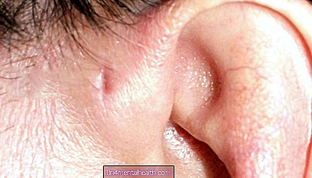 先天性耳瞼とは何ですか？ - 皮膚科