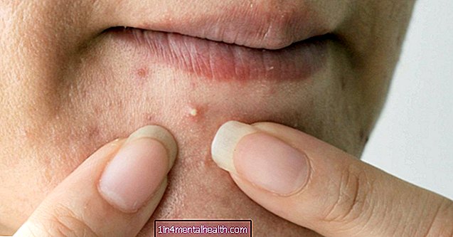 Шта учинити са бубуљицама на бради - дерматологија