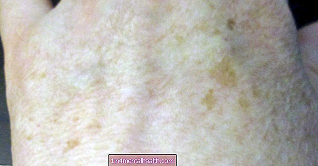 Cosa fare in caso di pigmentazione - dermatologia