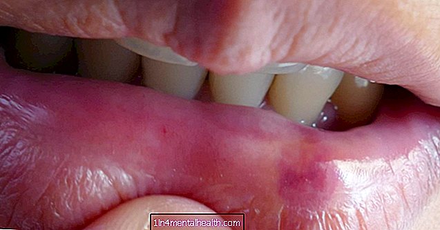 Apa yang perlu dilakukan untuk bibir yang pecah - dermatologi