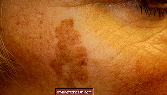 Što znati o staračkim pjegama - dermatologija