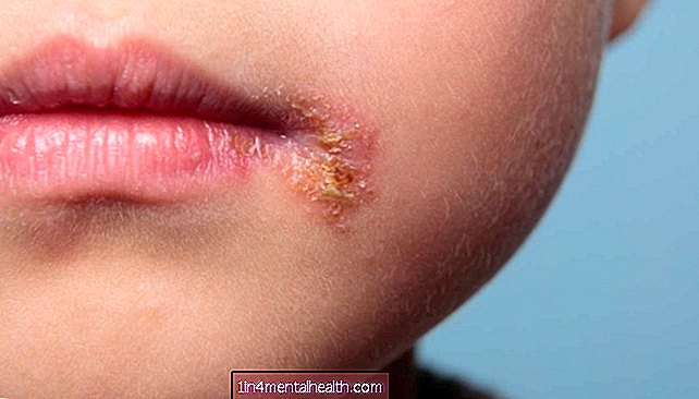 शिशुओं और ठंडे घावों के बारे में क्या जानना है - त्वचा विज्ञान