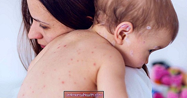 Qué saber sobre la varicela en los bebés