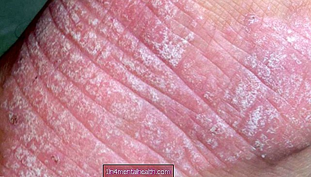 Što znati o dermatitisu herpetiformisu