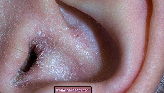 Co vědět o ušním ekzému - dermatologie