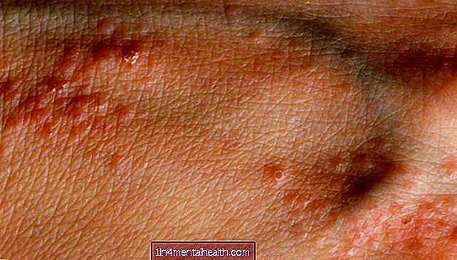 Cosa sapere sui brufoli alle mani - dermatologia