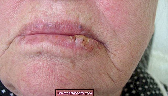 Was Sie über Lippenkrebs wissen sollten - Dermatologie