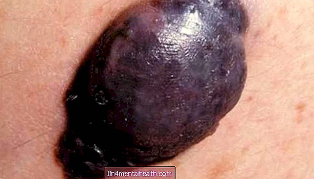 Kas jāzina par mezglveida melanomu - dermatoloģija