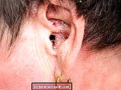 Какво да знаете за псориазис в ушите - дерматология