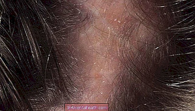 Co vědět o infekcích pokožky hlavy - dermatologie