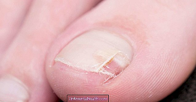 Vad man ska veta om delade naglar