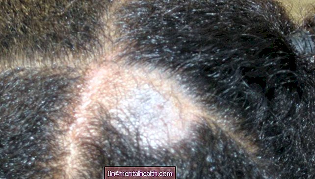 Những điều cần biết về bệnh nấm da đầu - da liễu