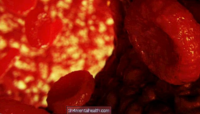 Kaip raudonieji kraujo kūneliai kenkia širdies ir kraujagyslių sveikatai sergant cukriniu diabetu - diabetas