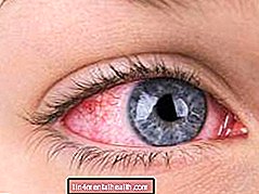 Co to jest zespół suchego oka i jak się go pozbyć? - wyschnięte oko