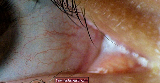 Kaj morate vedeti o točkovnih čepih za suho oko - suhe oči