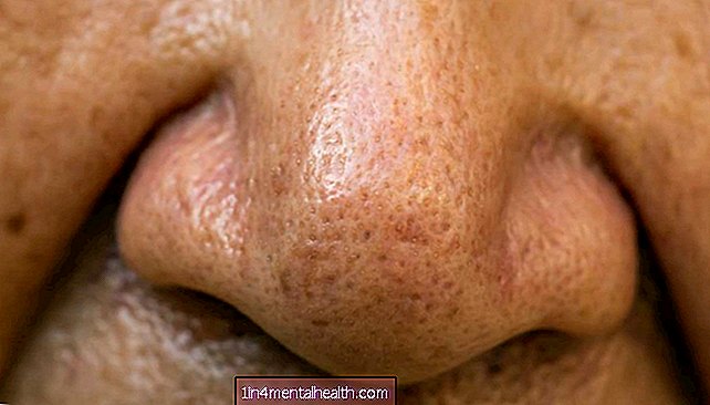 Mal sentido del olfato relacionado con un mayor riesgo de mortalidad - oído-nariz-y-garganta