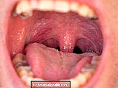 Was verursacht eine geschwollene Uvula? - Hals-Nasen-Ohren