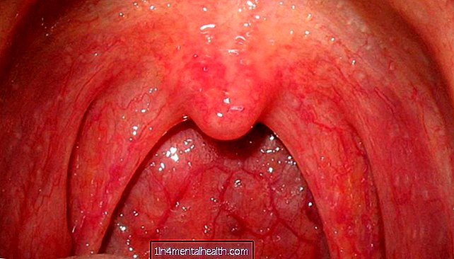 Какво причинява подутини в задната част на гърлото?