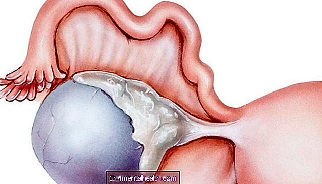 Vad man ska veta om komplexa cystor på äggstockarna - endometrios