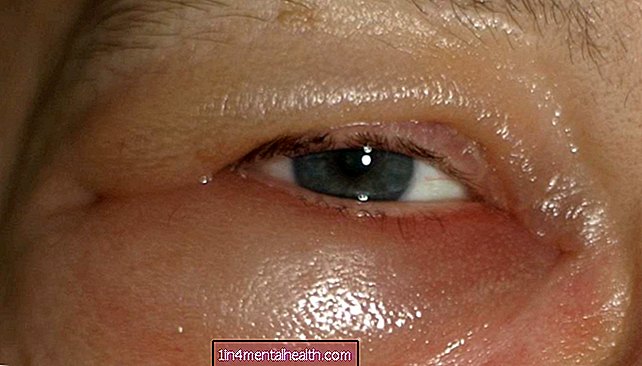 Kako se riješiti natečenih očiju? - zdravlje očiju - sljepoća