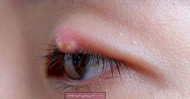 Kaip gydyti ar atsikratyti dažų - akių sveikata - aklumas