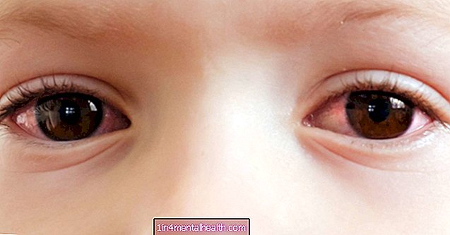 Rozā acs mazuļiem: Viss, kas jums jāzina - acu veselība - aklums