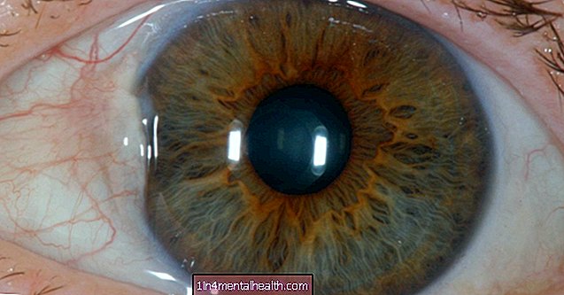 ¿Qué causa los bultos en el globo ocular? - salud ocular - ceguera