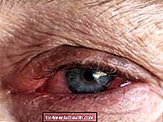 Що таке інфекційний кон'юнктивіт, або мізинець? - здоров'я очей - сліпота